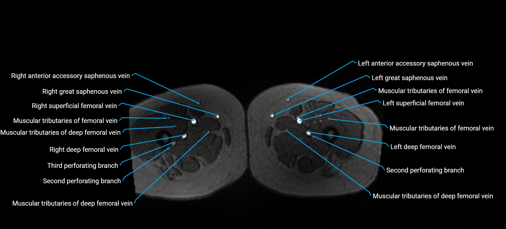 MRV abdomen pelvis & lower limb axial cross sectional anatomy labelled MRI image 239 (1).webp